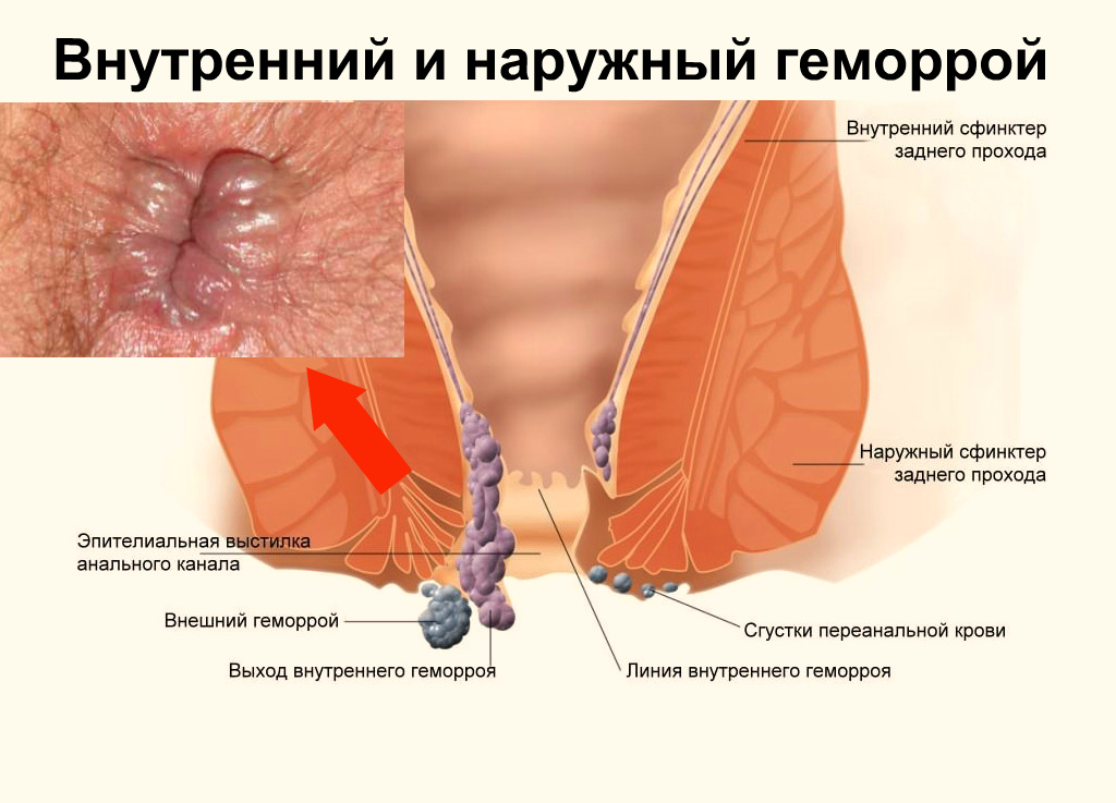 Средства от геморроя